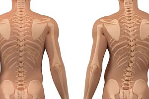 脊柱侧弯怎么解决?脊柱侧弯的调理思路