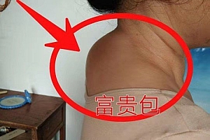 富贵包是怎么形成的?富贵包的解决办法