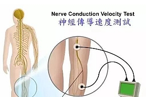 坐骨神经痛的形成原因与调理方法