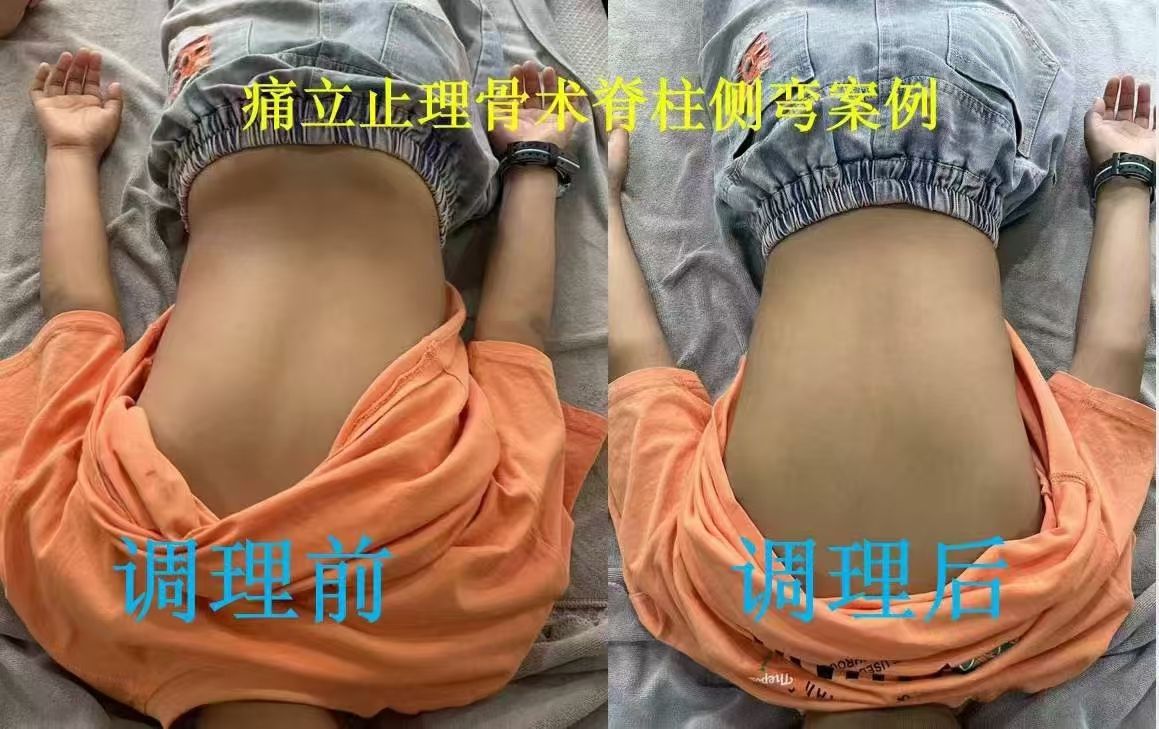 脊柱侧弯怎么解决?脊柱侧弯的调理思路
